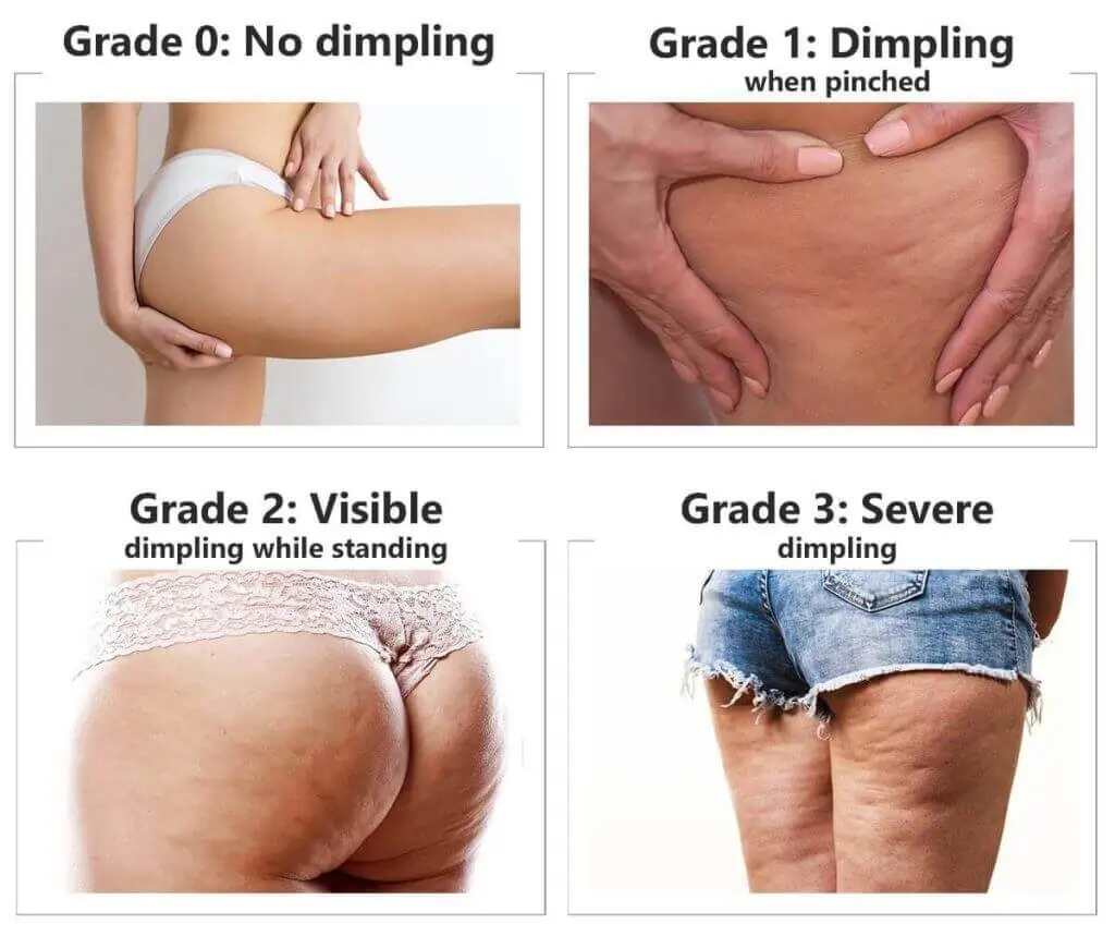 Representation of the stages of cellulite development Hastings